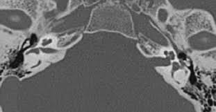 Image result for Ossicular Chain Disruption