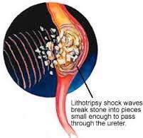 Lithotripsy Dr Ziauddin Hospital