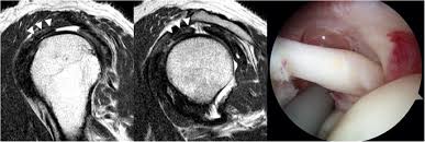 $800 pesos ($43.24 usd) mri of lumbar spine without dye: Accuracy Of Mri In Diagnosing Intra Articular Pathology Of The Long Head Of The Biceps Tendon Results With A Large Cohort Of Patients Bmc Musculoskeletal Disorders Full Text