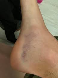 Gibt es eine allgemeine regel, wann man bei 'nem umgeknickten fuß zum arzt zum röntgen gehen sollte, oder wann man einfach warten kann? Umgeknickt Und Auf Der Anderen Seite Vom Fuss Blau Gesundheit Und Medizin Korper Arzt