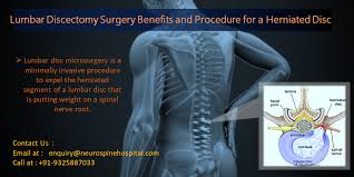 The Lumbar Disc Microsurgery In India Can Help In Fixing Disc Condition When The Conservative Approach Has Failed Read Mo Lumbar Disc Herniated Herniated Disc