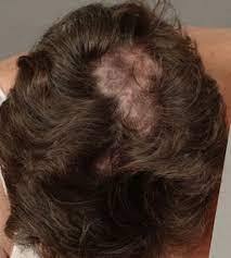 Because lupus causes widespread inflammation throughout the body just because you may be experiencing hair loss does not mean that you have lupus. Alopecias In Lupus Erythematosus Lupus Science Medicine