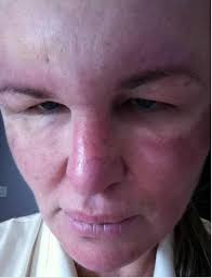 Busque atención médica de emergencia si usted tiene signos de una reacción alérgica: Las Inyecciones De Belleza Hicieron De Esta Mujer Un Monstruo Fotos Difundir Org