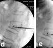 Comparison of a flexible versus rigid bone cement injection ...