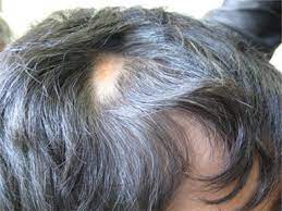 Remembering how devastating that experience was and how cruel some kids can be, she knew she didn't want other children to experience the same things. Hair Loss In Children Etiologies And Treatment Intechopen