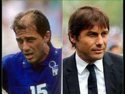 Sky sports reported wednesday afternoon that conte is leaving inter by mutual consent. Antonio Conte Chelsea Fc Coach 3 Hair Transplants Youtube