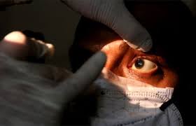 El llamado hongo negro que afecta las vías respiratorias dándoles ese color oscuro al provocar la enfermedad conocida como mucormicosis. 5uukumk5zcpmom