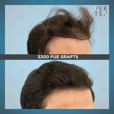 The hairline typically pulls backward from the in terms of the receding hairline, stage 3 vertex balding is a less drastic version of stage 3. This Gentleman Had Some Diffuse Hair Vertex Hair Clinic Facebook