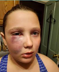 The Necessity of Face Masks in Softball for Preventing Injuries