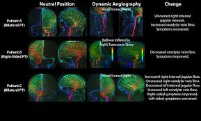 Research has demonstrated that tinnitus is related to inflammation in the inner ear. Pulsatile Tinnitus Causes And Treatments Ucsf Radiology