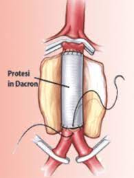 Un aneurisma che interessa la porzione addominale dell'aorta è detto aneurisma dell'aorta addominale. Riparazione Endovascolare Dell Aneurisma Dell Aorta Addominale Sassuolo 2000