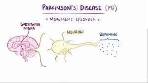 Check spelling or type a new query. Parkinson Disease Video Explanation Osmosis