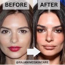 ONLY BOTOX? Only admitting to Botox? What do you think? Brow lift? Cheek  filler or implants? Buccal Fat removal? Lip filler !!! Emily Ratajkowski:  THEN AND NOW ✨ She's stunning, but is