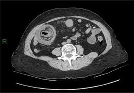 Image result for Adult Intussusception