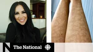 The beam is absorbed by the melanin present in t. Laser Hair Removal Leaves Woman With Intense Scarring Youtube