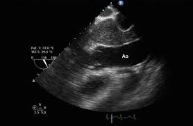 Pericardial mesothelioma develops in the lining of the heart and is the rarest form of the cancer. Case Report Of Aggressive Primary Pericardial Mesothelioma Presenting As A Constrictive Pericarditis Circulation Cardiovascular Imaging