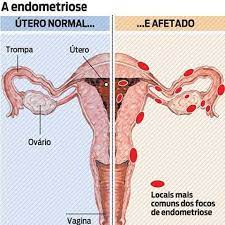 A endometriose é uma doença crônica que pode ser dolorosa. Endometriose Hospital Das Clinicas De Botucatu
