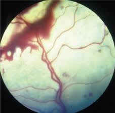 There are numerous causes of retinal detachment in the cat but acute trauma is one of them. Feline Primary Hyperaldosteronism Clinical And Surgical Approach Companion Animal