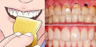 不用洗牙 六個方法就能去除牙菌斑 再也不怕洗牙痛痛了 helpful hints healthy life oral care