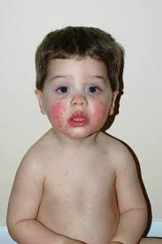Da der hautausschlag nur bei einem viertel der betroffenen auftritt, gibt es alle paar jahre epidemien in kindergärten und schulen. Erythema Infectiosum Padiatrie Msd Manual Profi Ausgabe