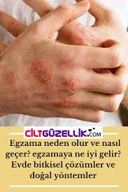 Egzama Nasil Gecer Egzamaya Ne Iyi Gelir Cilt Guzellik 2021