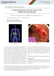 Remission means that the cancer has gotten smaller, almost always because of a treatment that has helped. Pdf Complete Remission Of Colon Cancer With Ipilimumab Monotherapy
