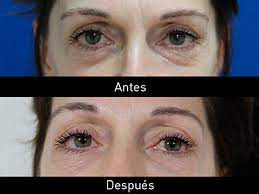 Redensity II, el mejor tratamiento para eliminar ojeras en Valencia
