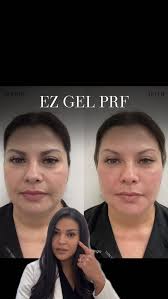 Listen as I talk through this patient and our treatment plan! So often  people think adding filler to the mid face will make their face look  bigger, when it can actually slim