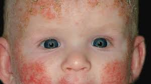 Heidelberger and others published atopisches ekzem | find, read and cite all the im mittelpunkt des behandlungkonzepts für das atopische ekzem im kindesalter steht die adjuvante basistherapie. Atopische Dermatitis Im Sauglingsalter Altmeyers Enzyklopadie Fachbereich Dermatologie
