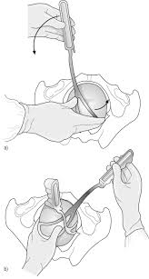 Image result for Forceps Assisted Delivery