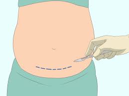 3 Simple Ways To Detect Pregnancy If You Have Pcos Wikihow