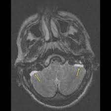 Enlarged Vestibular Aqueduct Syndrome Eurorad