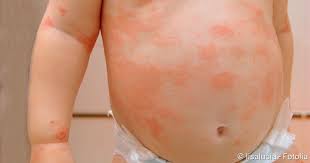 The more you scratch or rub neurodermatitis, the itchier it often becomes. Neurodermitis Bei Baby Kind Anzeichen Tipps Netdoktor