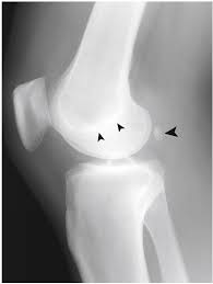 Image result for Knee XRay