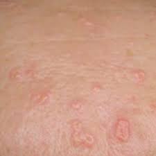 Image result for Sebaceous Hyperplasia