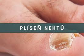 Image result for mykoza nehtů