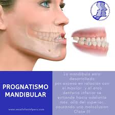 Placas de titanio en la Cirugía Ortognática La Cirugía Ortognática tiene  una duración de cuatro horas aproximadamente (se realizará bajo anestesia  general) y se realiza mediante incisiones intraorales. De esta manera, no