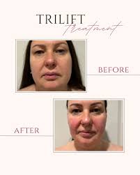 TriLift is a non-invasive, facial rejuvenation treatment that combines  three technologies to improve the appearance of the face and neck: Dynamic  Muscle Stimulation (DMSt): Strengthens and defines facial muscles to create  a