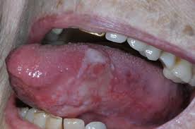 Image result for lichen planus on tongue)