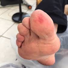 Image result for Chilblains