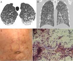 Image result for Strongyloides