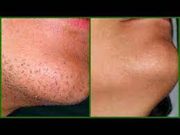 Stop Facial Hair From Growing In 30 Day Hair Will Take Longer To Grow Back Chin Hair Upper Lips Youtube Chin Hair Growing Facial Hair Chin Hair Removal
