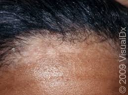 Image result for Seborrheic Dermatitis