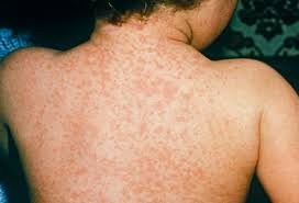 Learn about symptoms and treatment of childhood rashes, such as eczema, ringworm and impetigo. Childhood Illnesses Every Parent Should Know