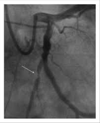 Coronary Artery Disease Identified The Arrow Shows A 90 Lesion In The Download Scientific Diagram
