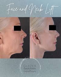✨ A remarkable transformation by Dr. Glazer! This face and neck lift  highlights the precision and artistry behind our natural, rejuvenated  results. Thinking about turning back the clock? Let's create a refreshed,