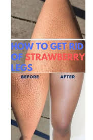 Get Rid Of Strawberry Legs Acne Strawberry Legs Body Skin Care Leg Acne