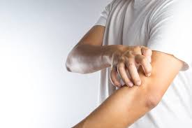 Neurodermitis (atopische dermatitis) bezeichnet eine chronische, schubweise verlaufende hauterkrankung, deren hauptursache eine unzureichende ausbildung der natürlichen barriereschicht der haut ist. Neurodermitis Ausloser Symptome Behandlung