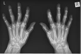 Pencil In Cup Deformity Rheumatoid Arthritis Radiology Case Radiopaedia Org
