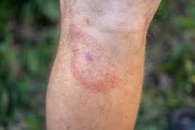 Image result for Tick Bite